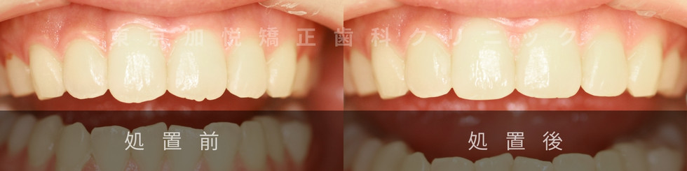 歯の形態修正前後写真