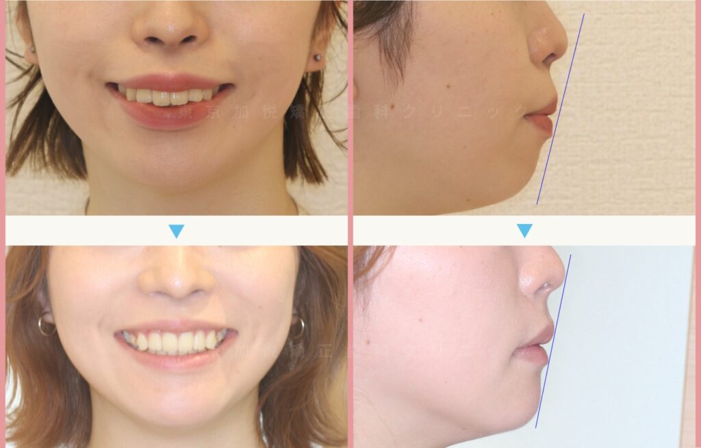 お口元の前突を全顎矯正（表側矯正）で治療した顔貌の治療前後写真