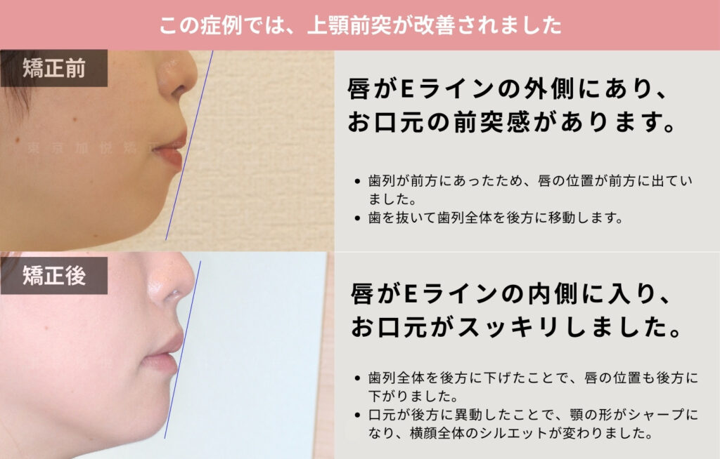 お口元の前突を全顎矯正（表側矯正）で治療した横顔の治療前後写真