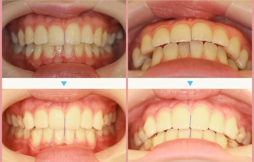 お口元の前突を全顎矯正（表側矯正）で治療した治療前後の正面写真