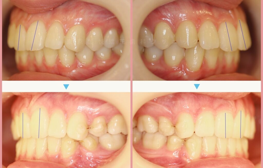お口元の前突を全顎矯正（表側矯正）で治療した横顔の治療前後写真