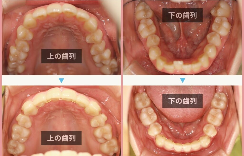 お口元の前突を全顎矯正（表側矯正）で治療した咬合面の治療前後写真