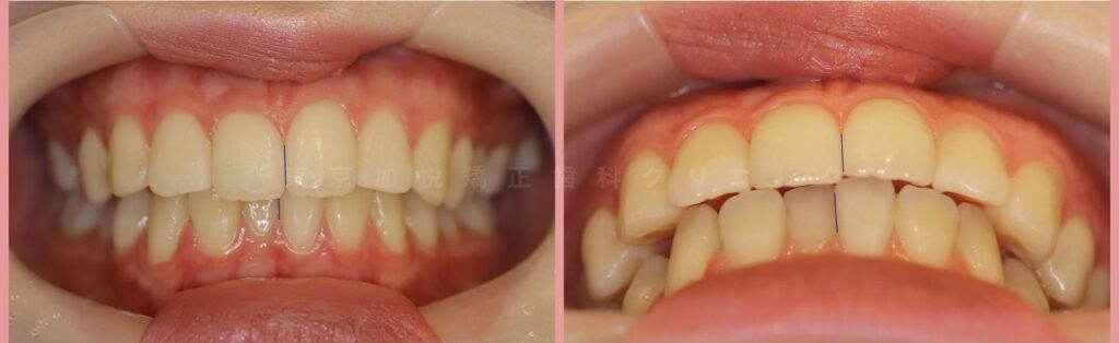 上顎前突の治療前写真