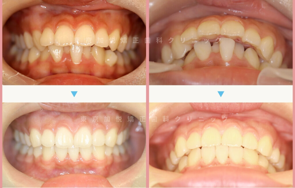 全顎矯正で上顎前突を改善した症例(正面の写真)