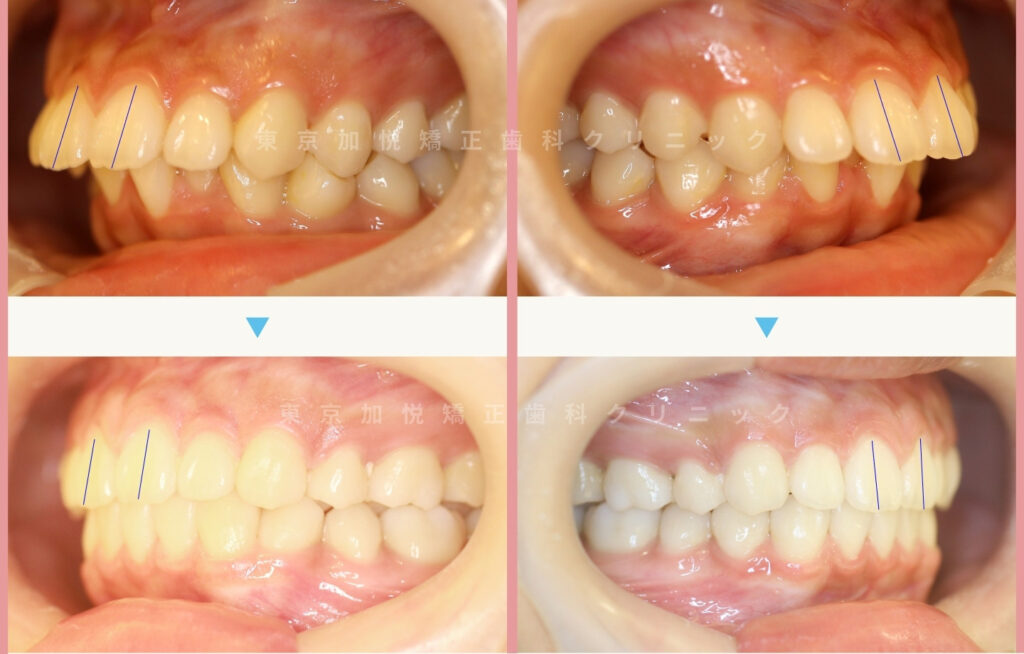 全顎矯正で上顎前突を改善した症例(正面の写真)