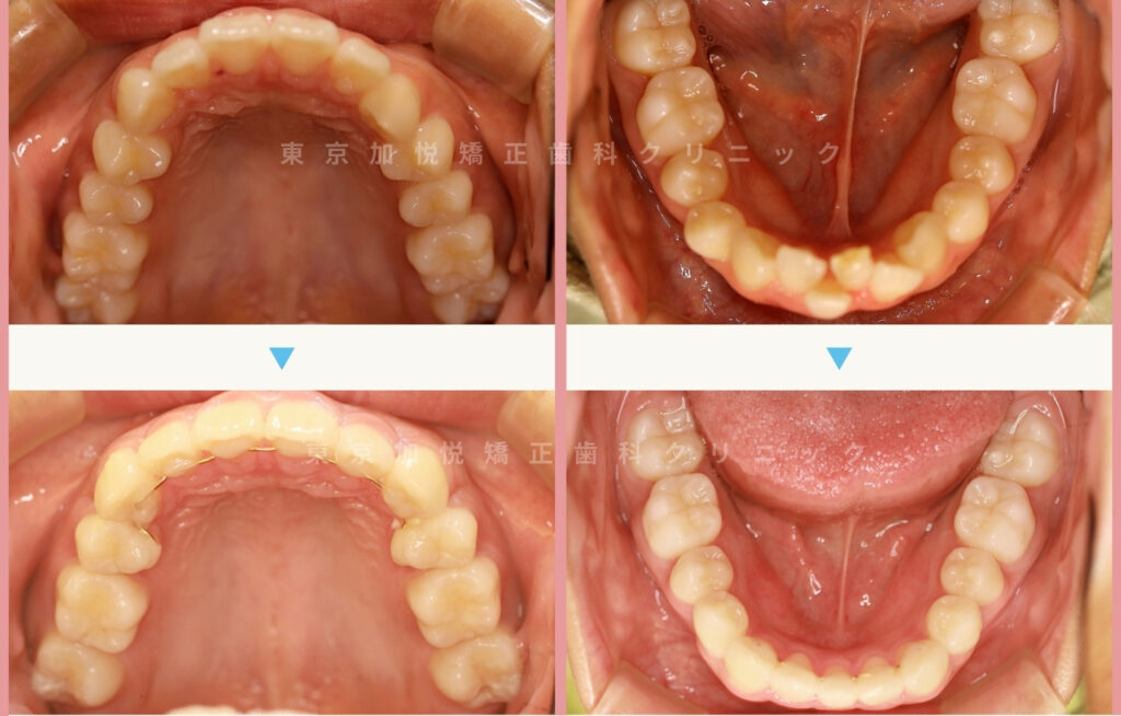 全顎矯正で上顎前突を改善した症例(咬合面の写真)