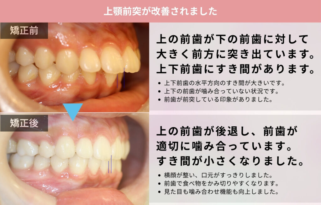 全顎矯正で上顎前突を改善した症例
