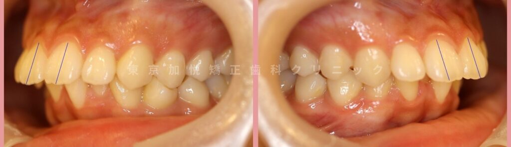 上顎前突の治療前写真(側方)