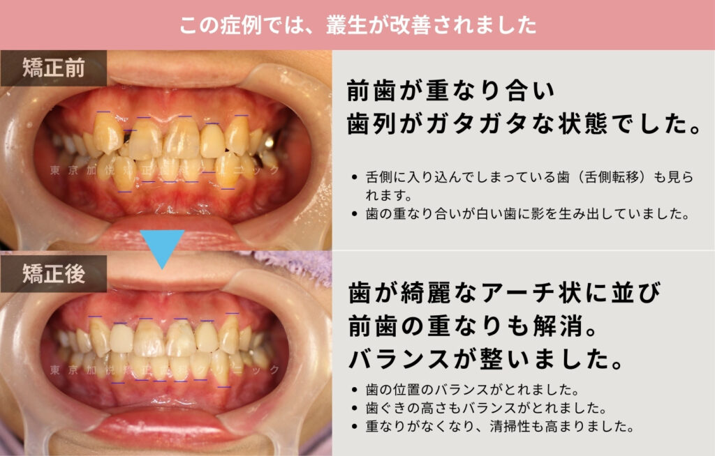 全顎矯正により前歯の重なりが改善され咬合も改善された治療前後解説写真