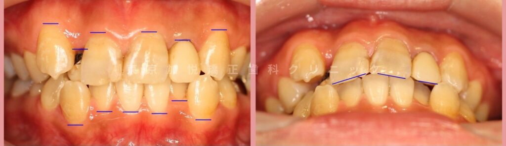 前歯の重なりや八重歯がある状態の治療前写真