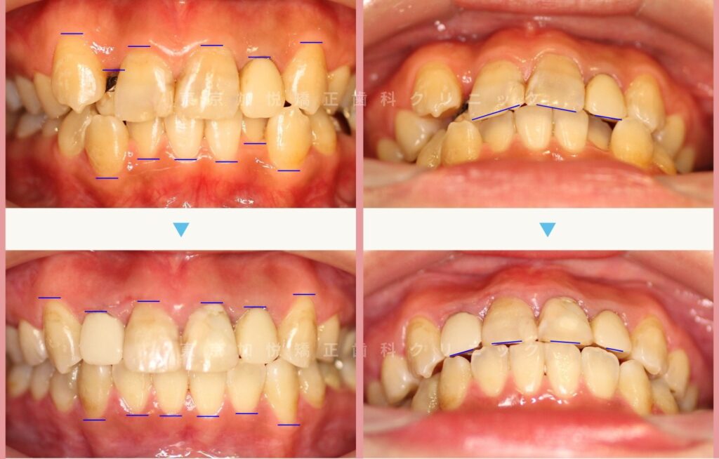 全顎矯正により前歯の重なりが改善され咬合も改善された治療前後正面写真