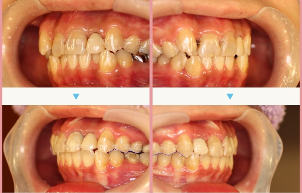 不正咬合・八重歯の症例で前歯の重なりがとれ咬合が改善された治療前後写真(サイド)