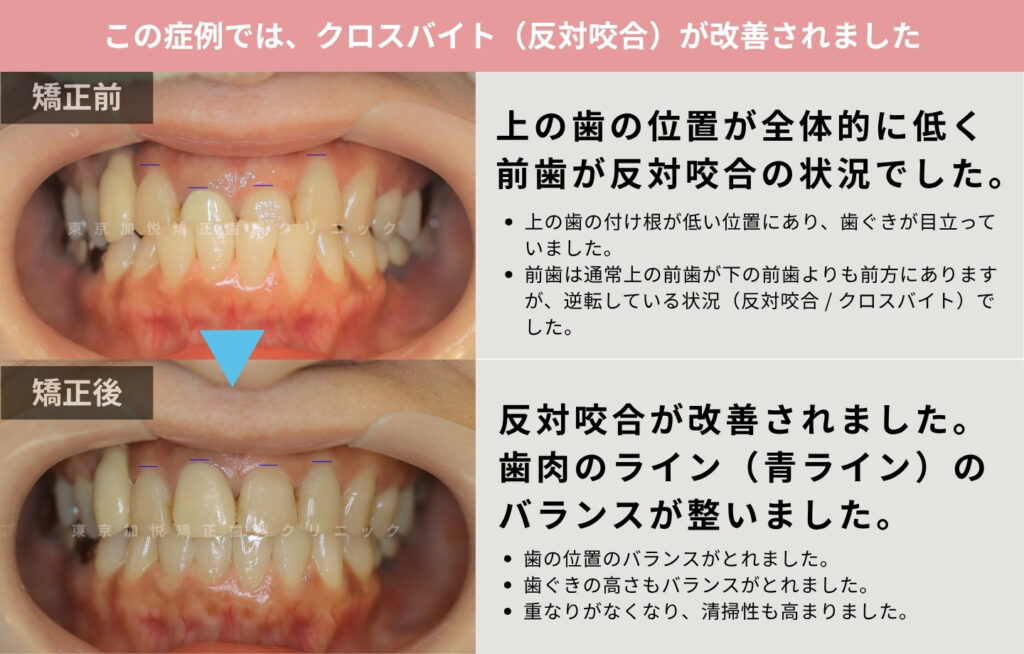 前歯の反対咬合を部分矯正で治療した症例の解説画像