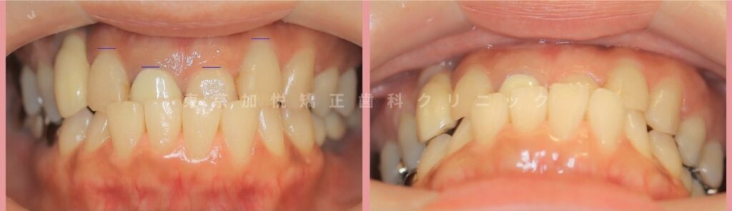 前歯の反対咬合