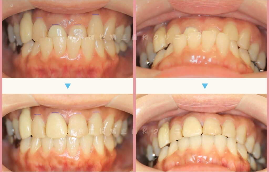 前歯のクロスバイト治療前後症例を正面からみた写真