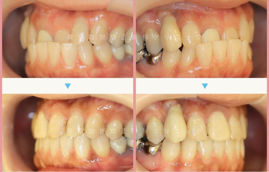 前歯のクロスバイトを改善した治療前後写真を斜めから見た写真