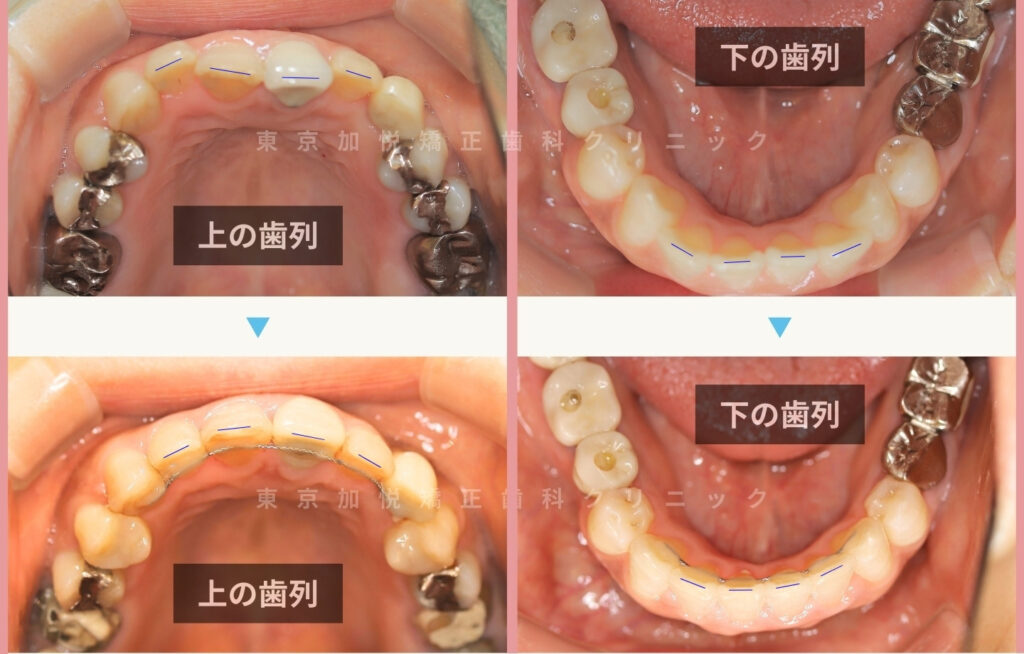 前歯のクロスバイト治療前後写真の咬合面