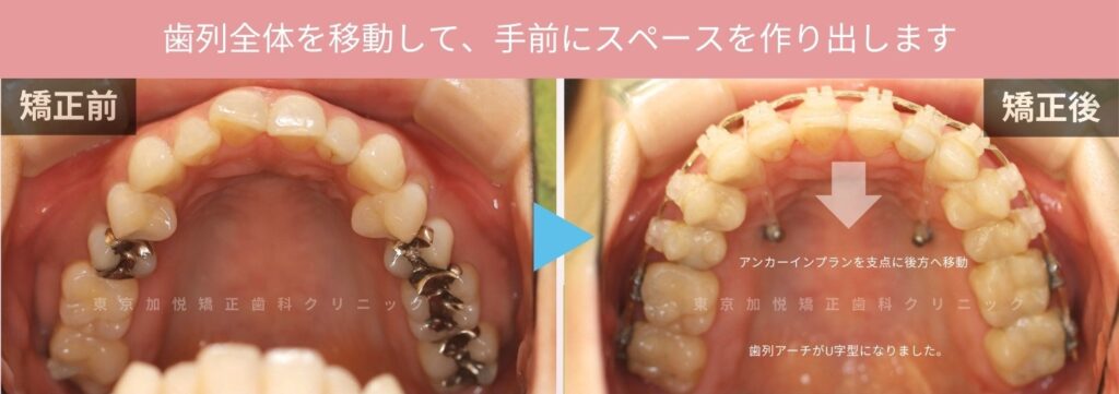 歯列全体を後方に移動した治療前後写真