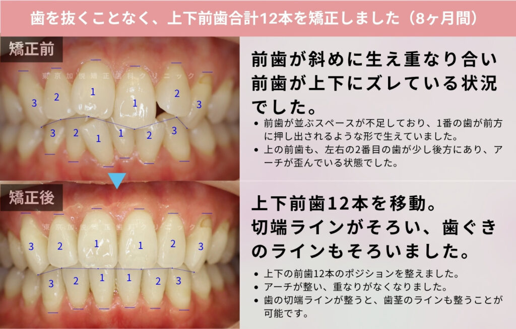歯を抜かずに部分矯正で叢生を治した症例の解説画像
