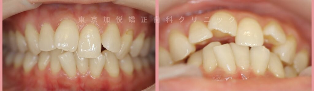 前歯の叢生・治療前の歯列写真