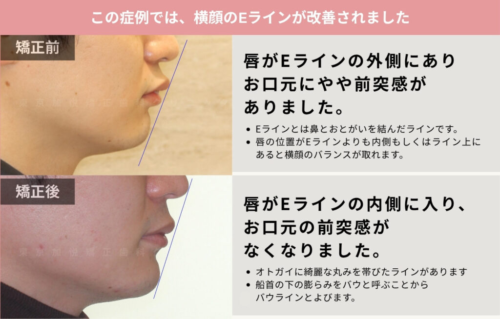 歯を抜かずにお口元の前突（出っ歯）を改善した症例。