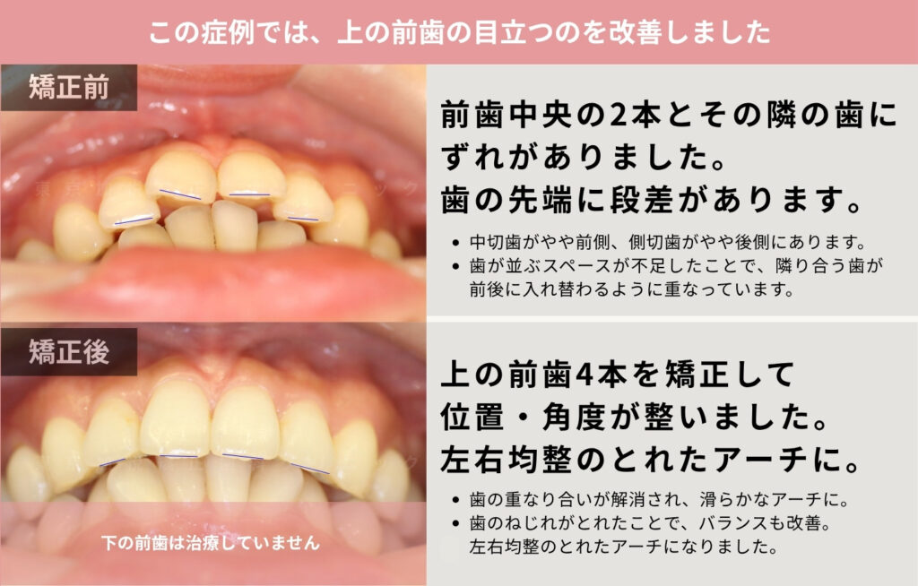 正面の前歯が目立っていた方の矯正治療前後解説画像