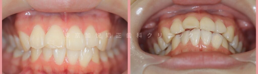 叢生と前歯を上下前歯の部分矯正で治療した患者様の治療前写真