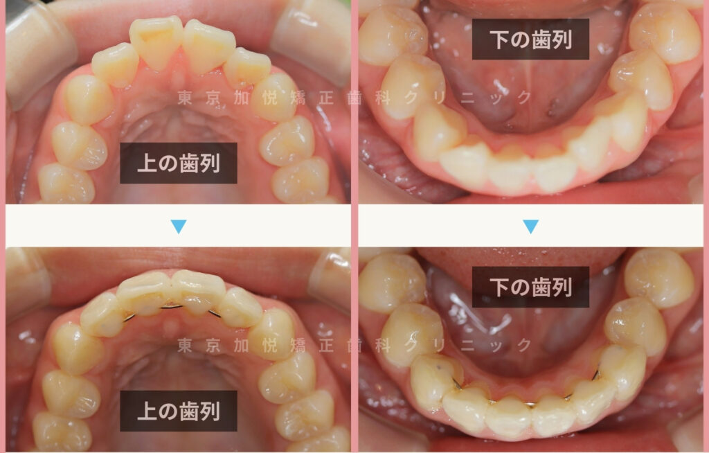7ヶ月間の部分矯正で前突と叢生を改善した症例の咬合面写真