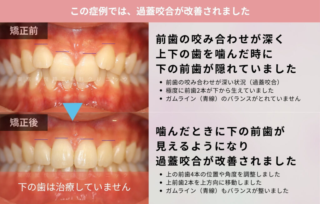 過蓋咬合を前歯4本の部分矯正で改善した症例解説(正面)