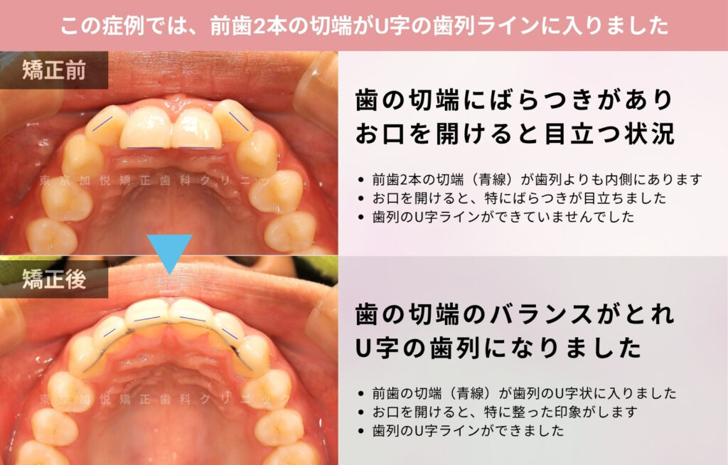 過蓋咬合を前歯4本の部分矯正で改善した症例解説(咬合面)