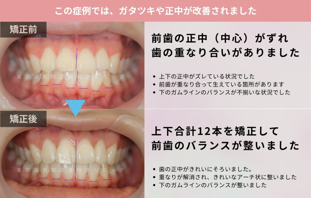 7ヶ月間の部分矯正で前突と叢生を改善した症例の正面からの写真（解説つき）