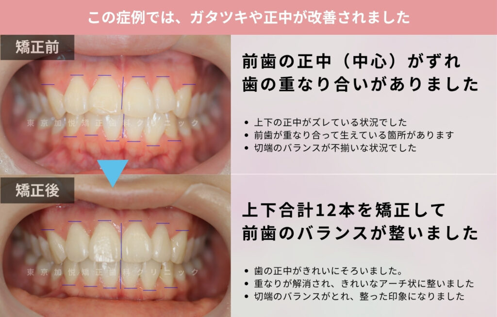 7ヶ月間の部分矯正で前突と叢生を改善した症例の正面からの写真（解説つき）