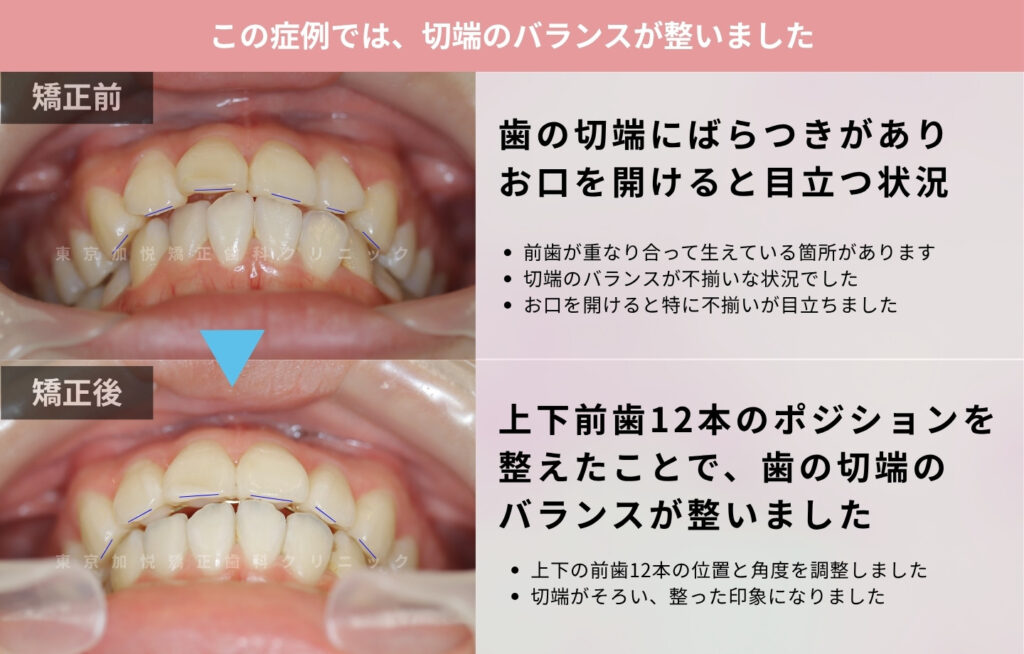 7ヶ月間の部分矯正で前突と叢生を改善した症例の正面下方からの写真（解説つき）
