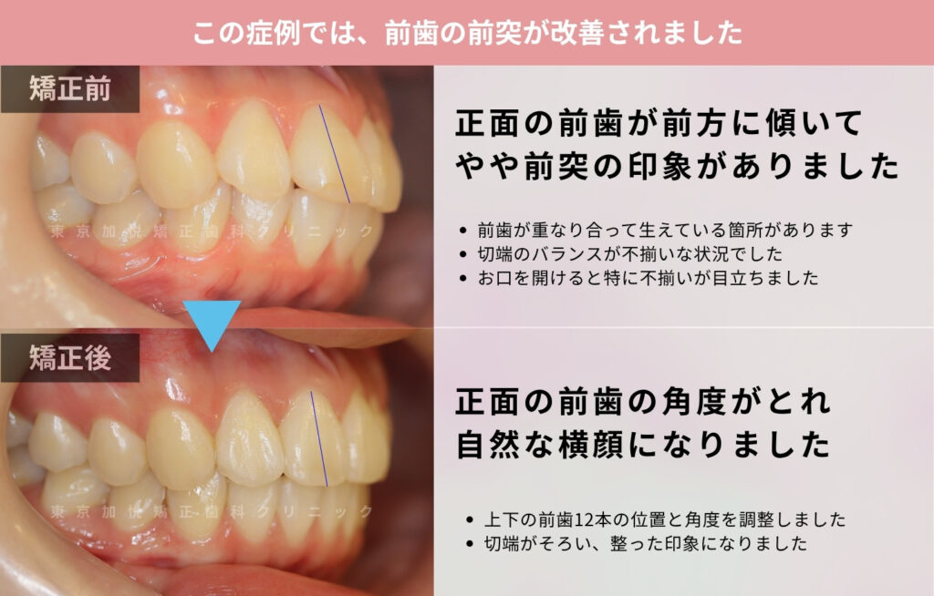 7ヶ月間の部分矯正で前突と叢生を改善した症例の横顔写真