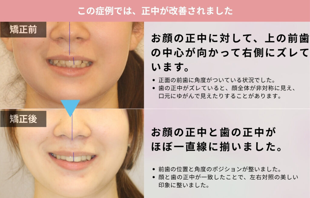 10代女性の患者様で歯の正中と顔の正中が一致した症例の解説