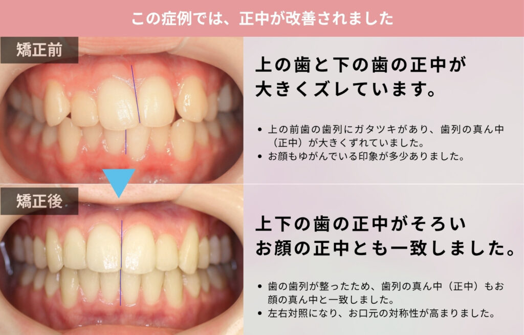 10代女性の患者様で上下の歯の正中が一致した解説画像