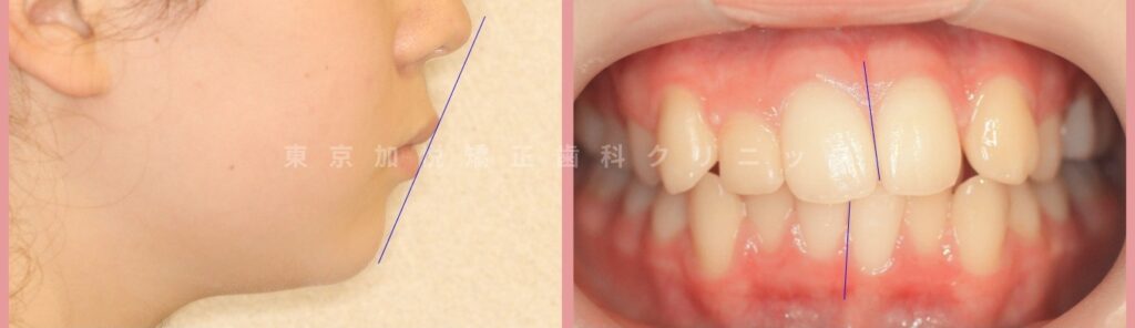 叢生の歯列と横顔写真