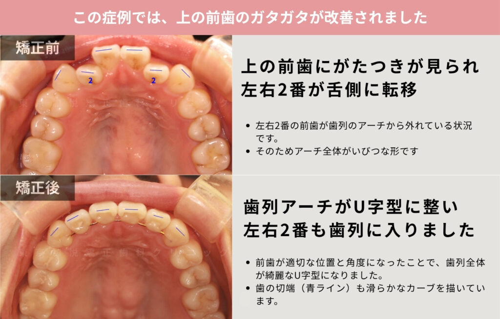 クロスバイトを部分矯正で改善した咬合面治療前後写真の解説画像