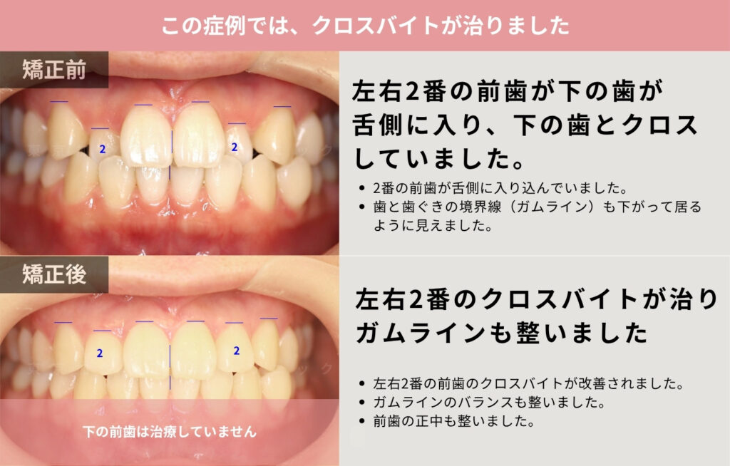 クロスバイトを部分矯正で改善した治療前後写真の解説画像