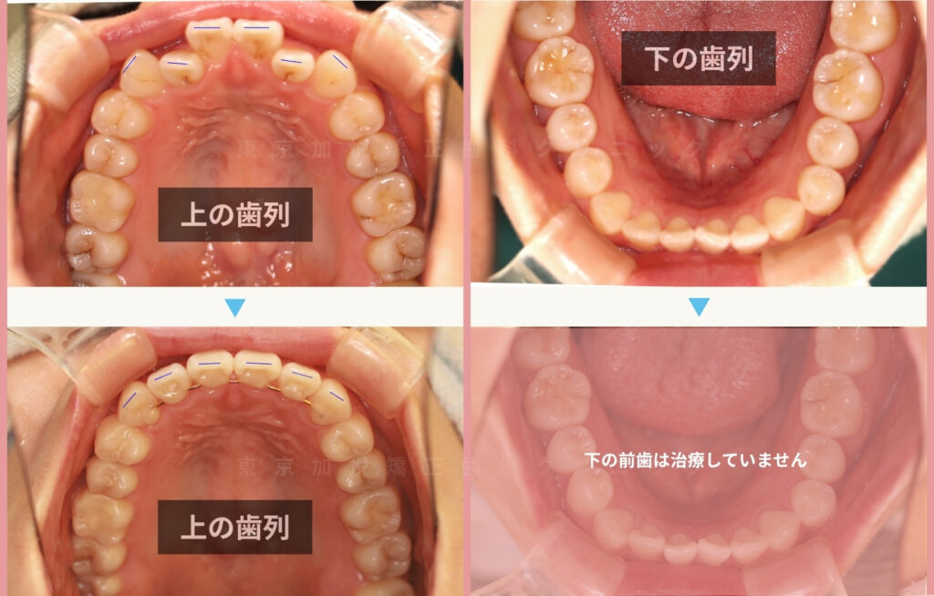 クロスバイトを部分矯正で改善した咬合面治療前後写真
