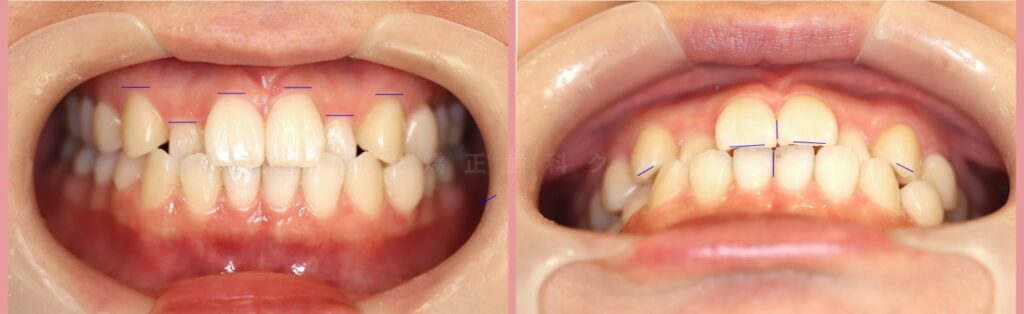 前歯の歯並びがガタガタしている状態の写真
