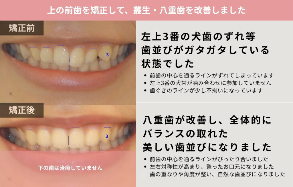 八重歯を上前歯の部分矯正で改善した症例(症例前後の解説写真)