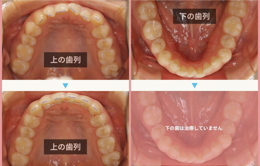 八重歯を上前歯の部分矯正で改善した治療前後写真(咬合面)