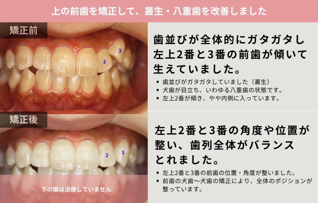 上の前歯を矯正して、叢生・八重歯を改善した症例の解説画像