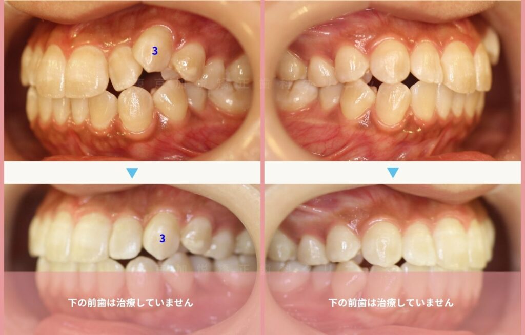 上の前歯を矯正して、叢生・八重歯を改善した症例、側方からの治療前後写真