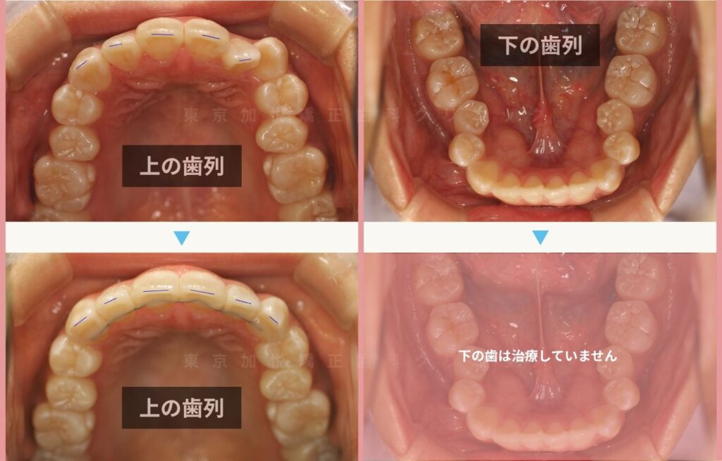 上の前歯を矯正して、叢生・八重歯を改善した症例、咬合面の治療前後写真