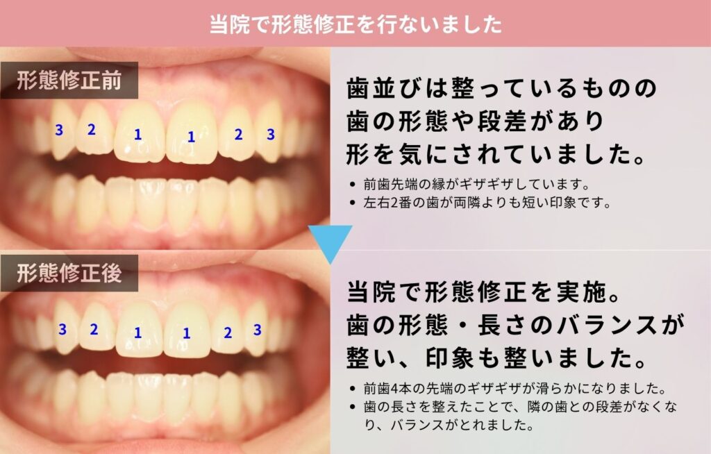 形態修正の治療前後写真解説画像