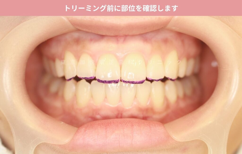 形態修正治療前に、トリーミング箇所を確認します