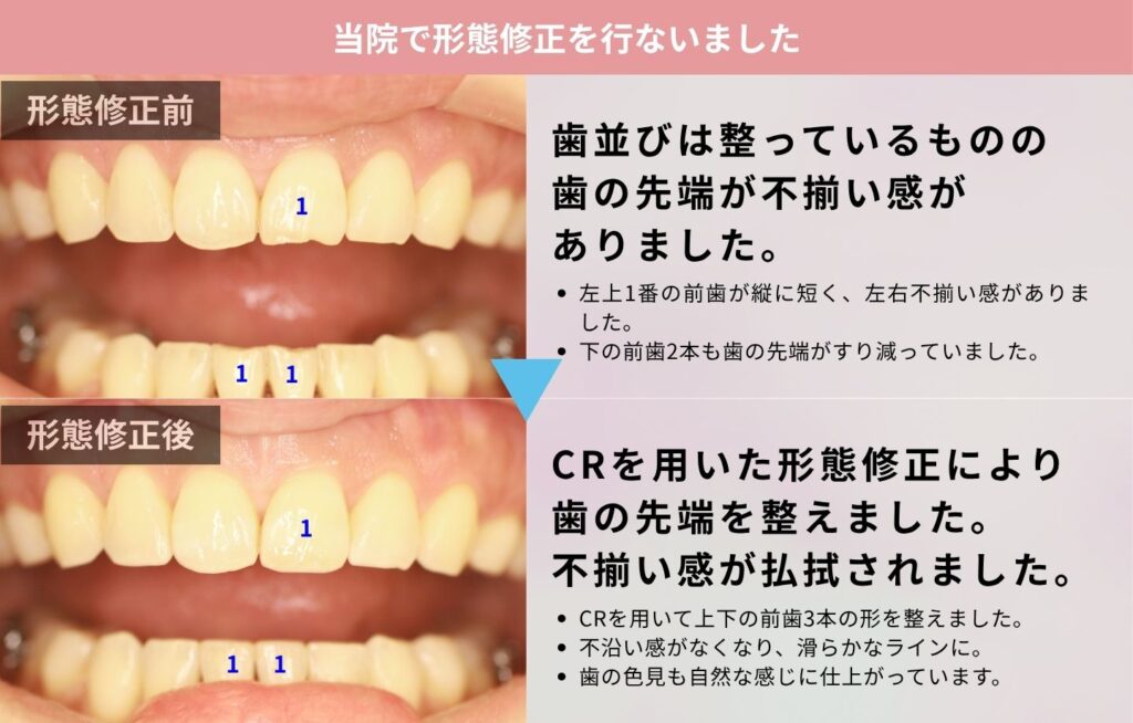CRで形態修正を行った症例の解説画像