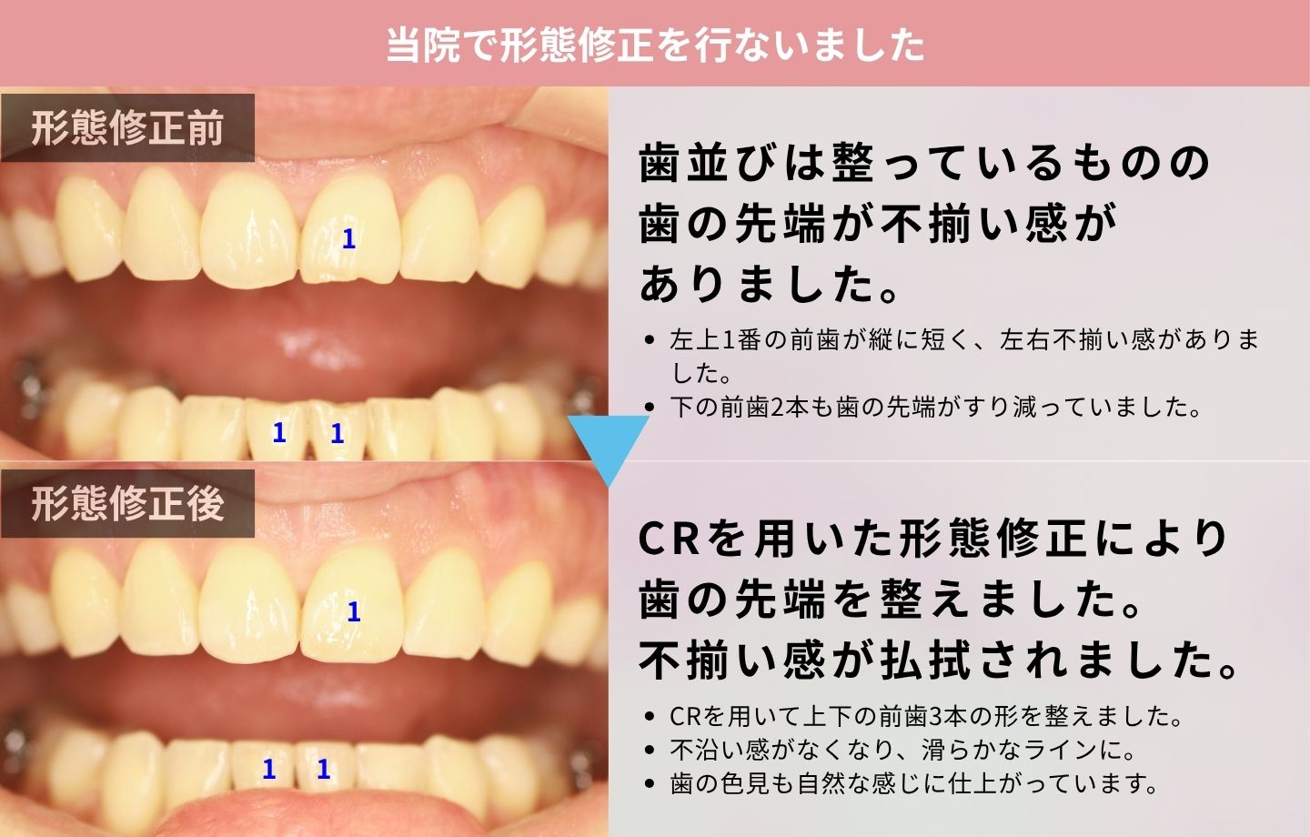 前歯のすり減りが気になる